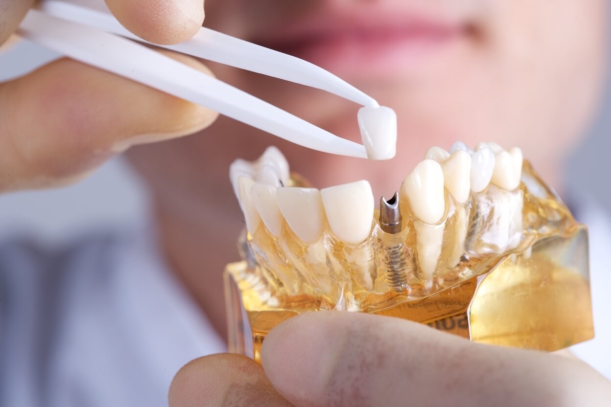ایمپلنت دندان (3)