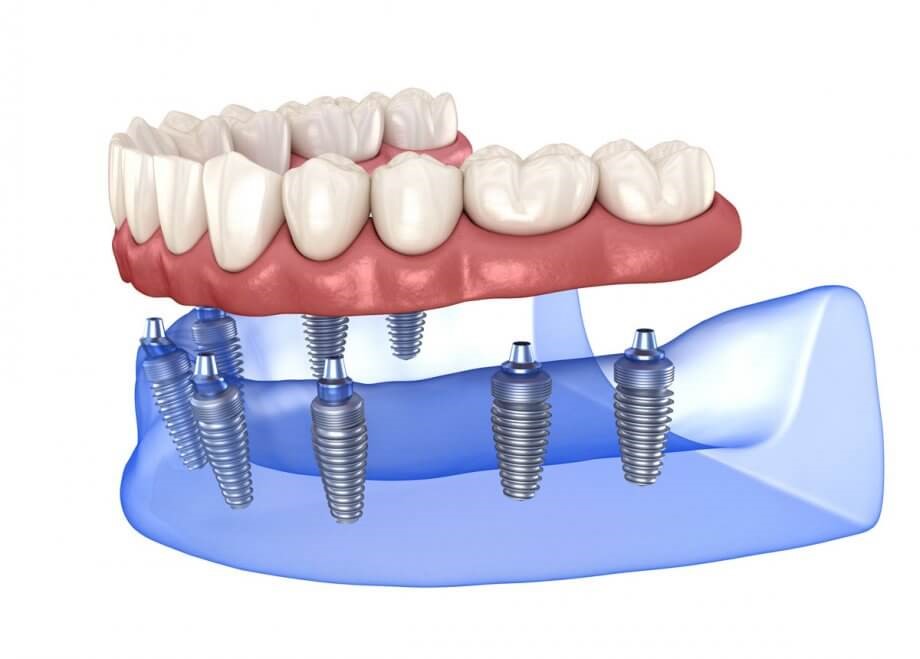 ایمپلنت دندان (2)