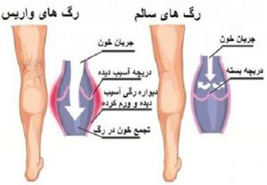 شیوع بیماری واریس در زنان چند برابر مردان است