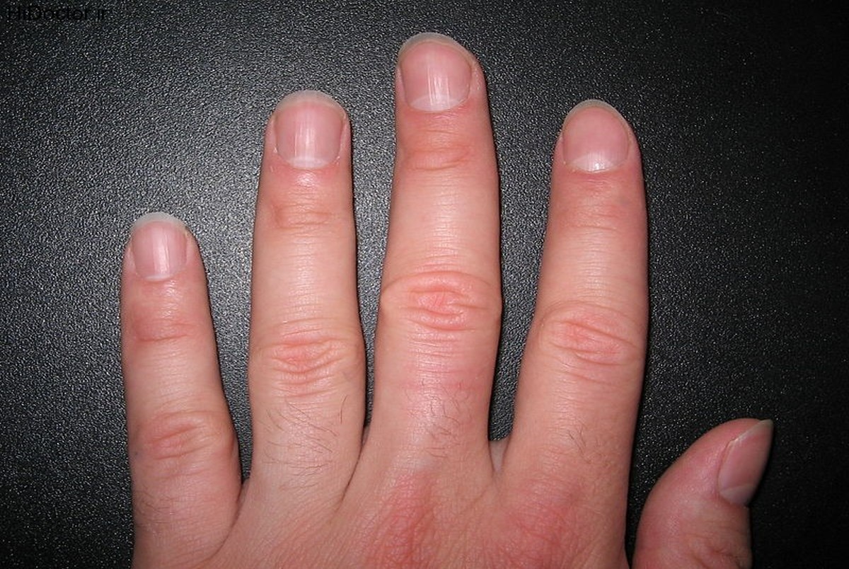 چرا روی ناخن لکه‌های سفید ایجاد می‌شود؟+ راه درمان
