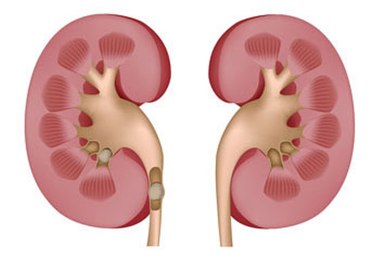 مصرف کم مایعات مهمترین علت تشکیل سنگ کلیه است