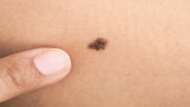 نشانه‌های سرطان پوست که نادیده گرفته می‌شوند
