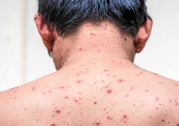 بررسی ورود واکسن آبله مرغان به واکسیناسیون کشوری