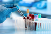 آزمایش خونی با تشخیص 50 نوع تومور سرطانی