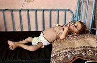 وخامت وضعیت سلامت کودک سه‌ساله غزه‌ای بر اثر سوءتغذیه و محاصره (1)