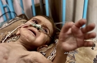 وخامت وضعیت سلامت کودک سه‌ساله غزه‌ای بر اثر سوءتغذیه و محاصره (3)