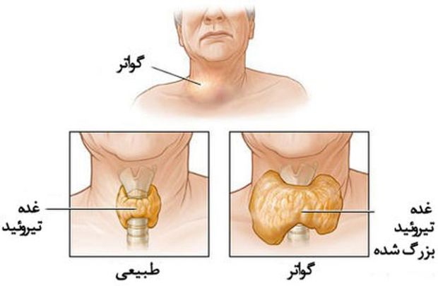 بیماری گواتر در خراسان رضوی کاهش یافت