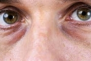 علت سیاهی زیر چشم چیست؟ + راهکارهای درمان