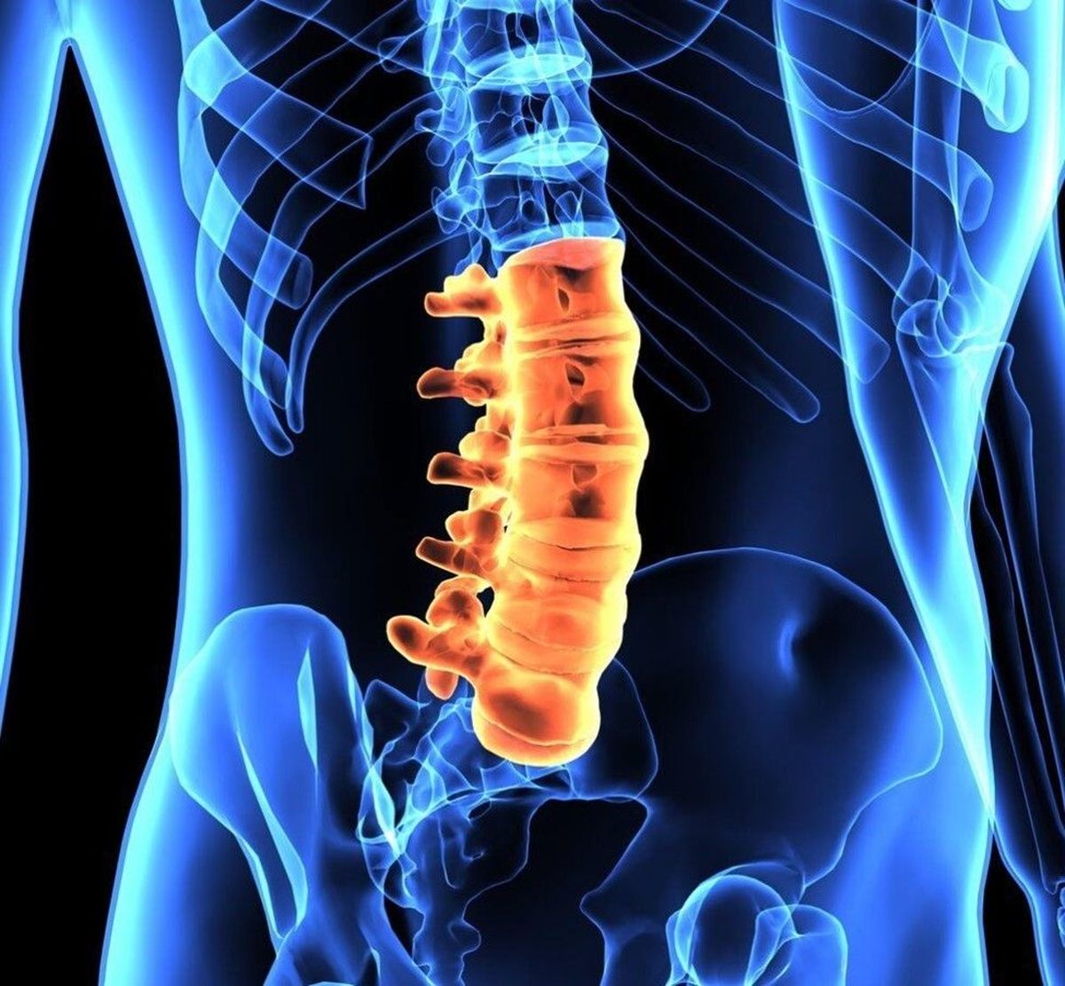 خطرناک ترین دیسک کمر و عوارض عدم درمان به موقع آن