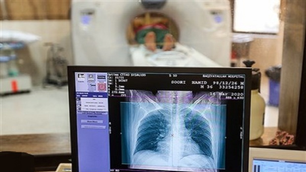 انجام سی تی اسکن ریه فقط برای بیماران کرونایی 
