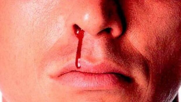 چرا خون‌دماغ می‌شویم؟
