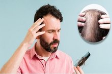 علت ریزش مو چیست؟ + راه های درمان
