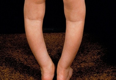 همه آنچه لازم است از پای پرانتزی کودک بدانید