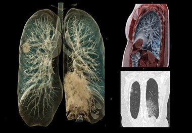 ماده ای جدید در ریه بیماران کرونایی شناسایی شد