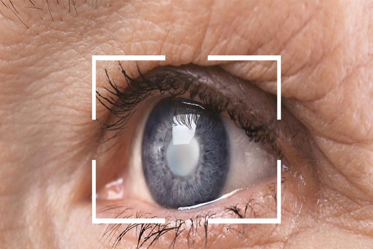 تولید قطره چشم نانویی برای کاهش التهاب و درد جراحی آب مروارید