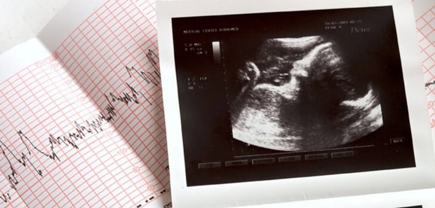 ماجرای حذف غربالگری ژنتیکی از کجا آب می‌خورد؟
