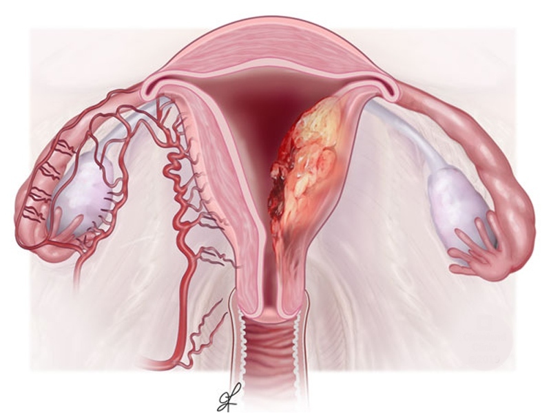سرطان دهانه رحم