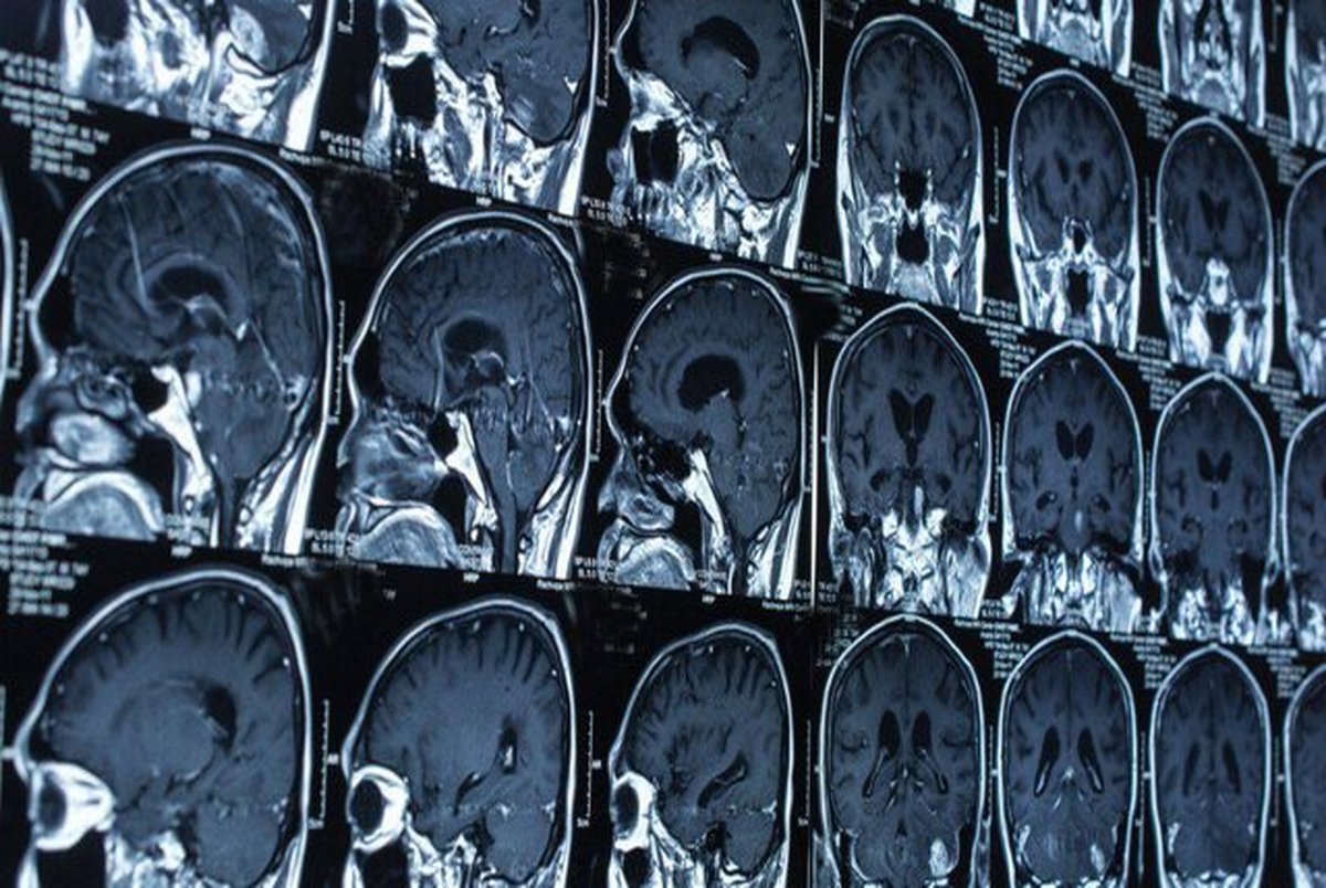 تشخیص میزان آسیب مغزی با هوش مصنوعی
