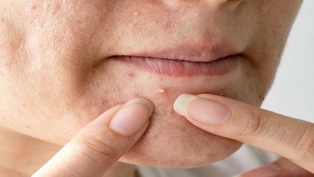 چی بخوریم تا جوش نزنیم؟
