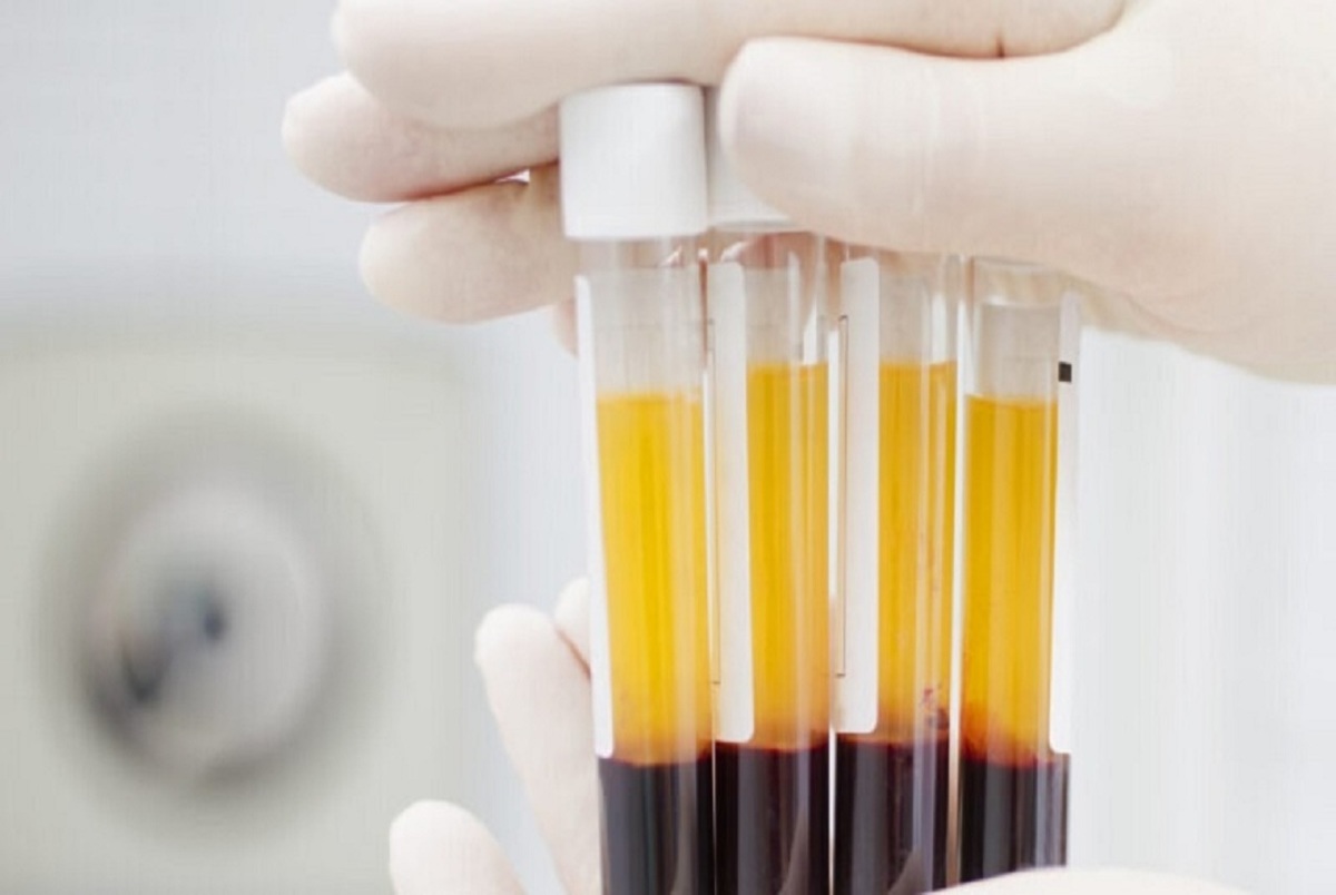 شرایط لازم برای اهدای پلاکت مستقیم خون