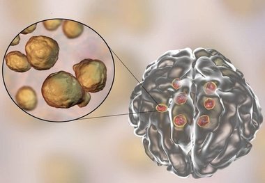 این عفونت در مغز منجر به اختلال حافظه می‌شود