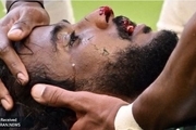 جام جهانی ۲۰۲۲| ترخیص مدافع مصدوم عربستان بعد از 2 عمل جراحی