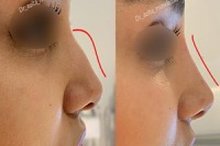 فریب فیلرهای ارزان و اینترنتی را نخورید