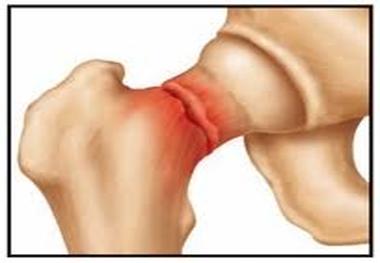 ارتباط مصرف زیاد ویتامین B و شکستگی استخوان لگن
