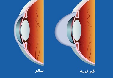 تفاوت قوز قرنیه و آستیگمات