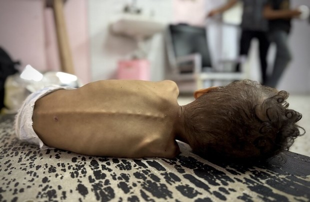 غزه: افزایش قربانیان قحطی و سوء تغذیه به ۲۶۳ نفر/ ۱۱۲ کودک در اثر گرسنگی جان خود را از دست دادند