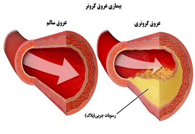 بهبود بخشی از بیماری عروق کرونر با رژیم درمانی