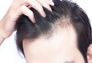 این داروی درمان ریزش مو باعث ایجاد افکار خودکشی می‌شود