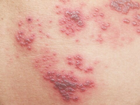 ویژگی‌های خاص واکسن زونا
