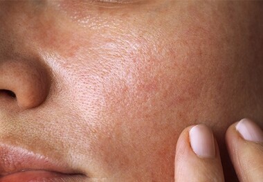 لکه‌های پوستی را چگونه درمان کنیم؟