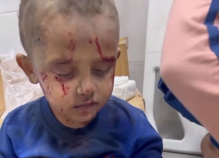 اشک کودک فلسطینی که در بمباران صهیونیست ها زخمی شد