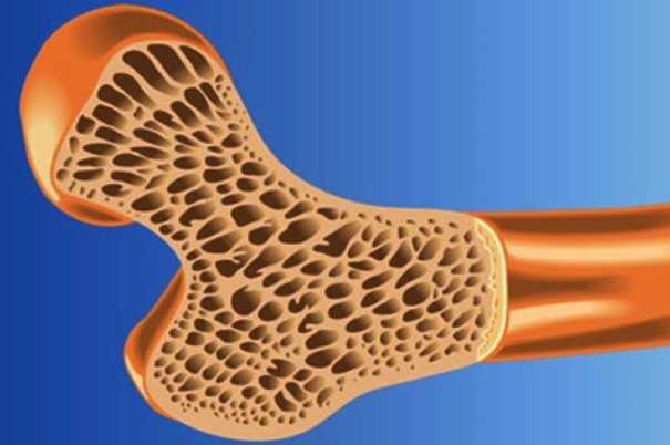 پوکی استخوان و ارتباط آن با ورزش و تغذیه