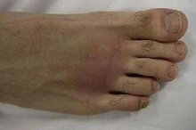 آیا نقرس بیماری پولدارهاست؟