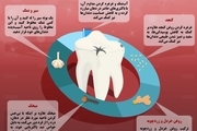 ۵ راه حل برای درمان پوسیدگی دندان‌/ اینفوگرافیک
