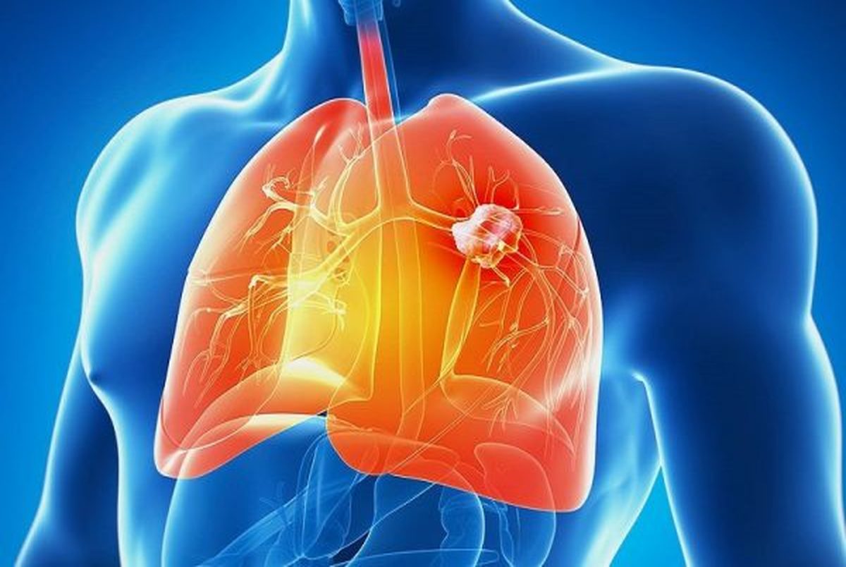 مهمترین نشانه‌های سرطان ریه
