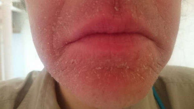 آلرژی نادری که زنان را درگیر می‌کند
