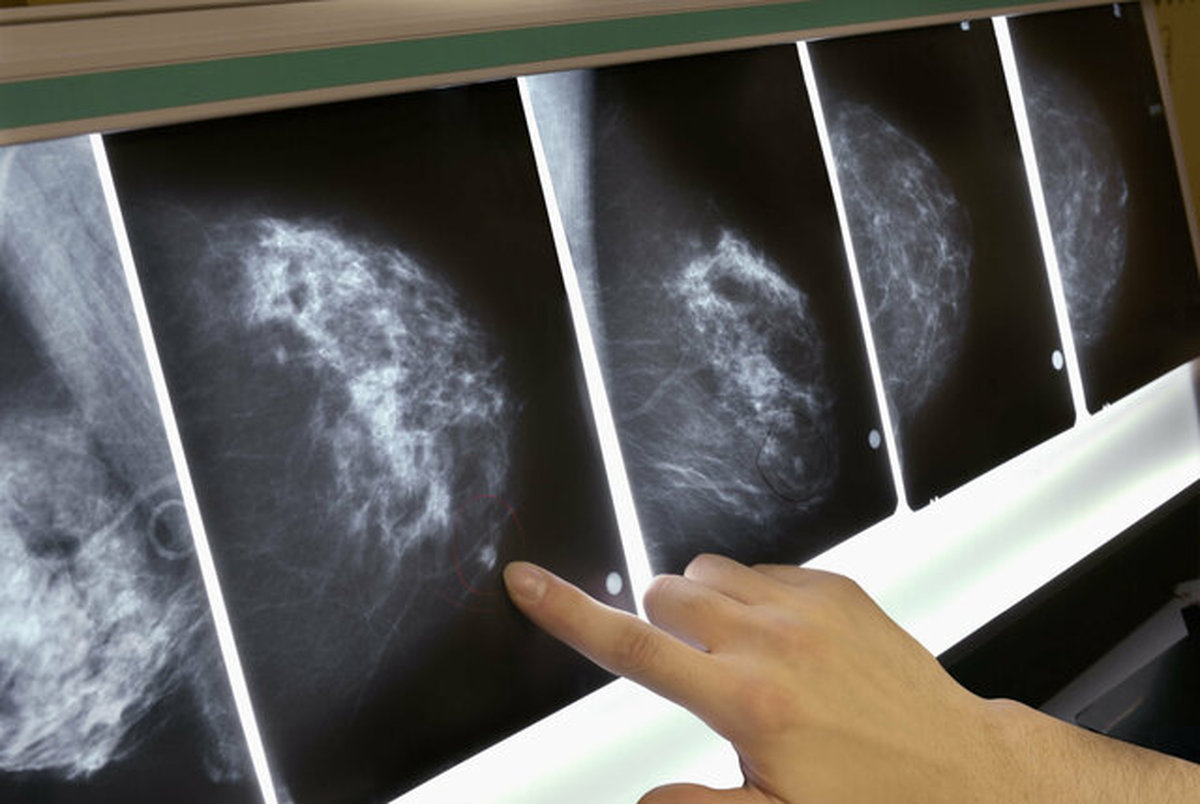 پیش بینی سرطان پستان 5 سال زودتر!