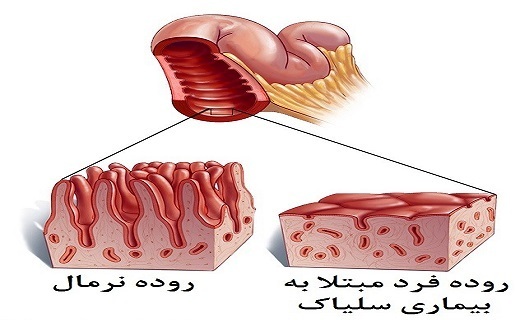  بیماری سلیاک 