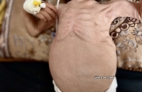 وخامت وضعیت سلامت کودک سه‌ساله غزه‌ای بر اثر سوءتغذیه و محاصره (4)